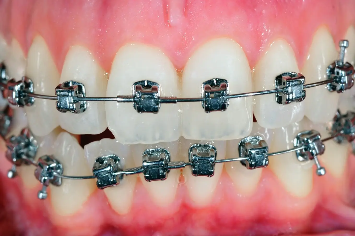 metalowy aparat ortodontyczny