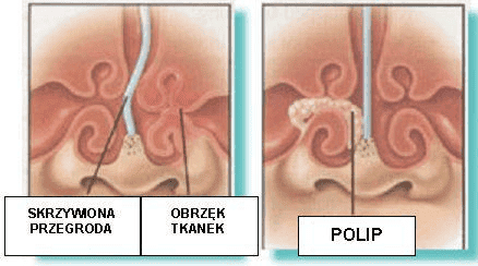 Grafika przegródki nosowej