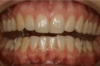 Dolna szyna na zębach
