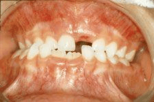 krzywe zęby