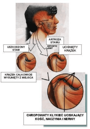 Rozwarstwiony model żuchwy